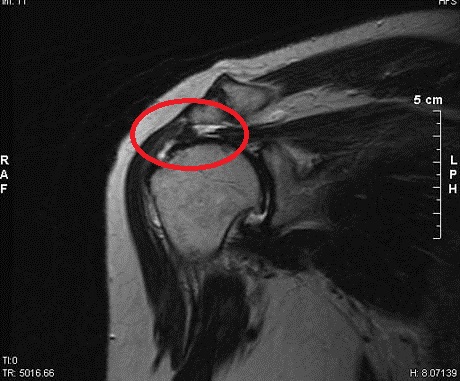 회전근개 파열 MRI.jpg